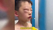 对作业过敏？小孩哥写作业时狂揉眼睛半小时，双眼肿成“外星人”