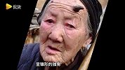 真“小龙人”?各国奇人因病头上长出犄角，像漫画人物！