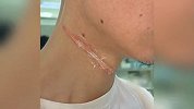 骑车男子被风筝线“割喉”倒地，脖子伤口触目惊心，事发监控曝光