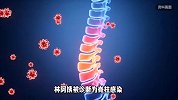 儿子好心买羊胎盘给病母进补，致其引发严重脊柱炎！医生紧急提醒