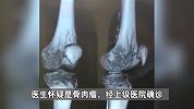 18岁抗癌博主晟宝去世！15岁查出骨肉瘤，医生曾建议截肢：手术勉强保肢后复发