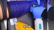 这是在拆石膏吗？看着好吓人啊