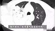 浙江一对夫妻宰杀活鸭被抓伤，两人统统被放倒住进ICU，医生提醒