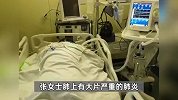 女子常逛公园看鸟，突然高烧不退、多脏器衰竭住进ICU，医生提醒