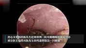 男子半夜睡梦中被疼醒，竟是耳朵里钻进蟑螂