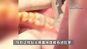 71岁老人补牙吞下3厘米钻头，顺着喉咙卡进小肠吓蒙患者：医生没敢告诉我