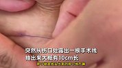 女子剖腹产9个月后肚皮上抽出10cm手术线：医生说线是可溶的