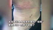 男子河里开摩托艇被鱼线“锁喉”：窒息感持续三四天，再快点脖子就断了