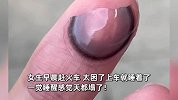 女子火车上睡觉忘摘美瞳，醒来发现美瞳碎在了眼睛里：特别疼