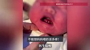 山东一婴儿刚出生嘴里就长着两颗牙，网友：不敢想妈妈喂奶该多疼！医生提醒