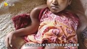 “缩骨功”现身？女孩患怪病全身收缩虚弱，看起来只有幼婴那么大！