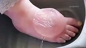 脚上这么大的泡看着都疼！
