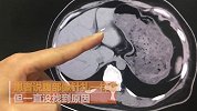 女子腹痛取出8年前鱼刺 在体内游走到肝脏