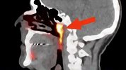 科学家发现人类新器官 对于癌症治疗非常重要 影像曝光
