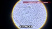 女童小区玩耍接触非洲大蜗牛，感染广州管圆线虫：治疗半年才停药出院