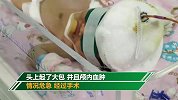 惊险！二胎孕妇在家散步时胎儿突然滑出 头先着地致颅内血肿