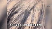 20岁女生失恋一个月，头发、眉毛、腋毛全部脱落，医生回应