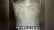 12岁误吞体温计32岁时取出！男子腹痛就医险些引发大出血，医生紧急提醒