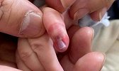 吓人！只因妈妈的一个错误动作 5个月大宝宝差点要截肢