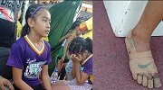 扎心！菲律宾11岁女孩没钱买跑鞋 用绷带裹脚参赛还拿3块金牌