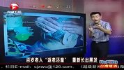 百岁老人返老还童重新长出黑发