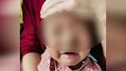 一岁半男孩被流浪狗咬掉半边鼻子 医生2小时手术成功修补