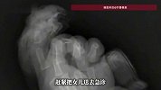 妈妈抱着娃用剪刀拆快递，不慎剪断7个月女儿食指！爸爸从沙发缝中找到断指火速送医成功接上