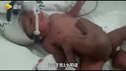 很心疼! 印度新生儿有两套生殖系统被送进ICU, 母亲认为她是礼物