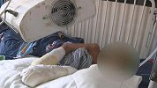 7岁男童疑遭父亲烟头烫满身伤疤 医生：若幸运可不截肢