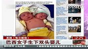 巴西女子生下双头婴儿
