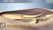 3D动画带你了解KD汤神伤情有多严重 愿伤病远离赛场