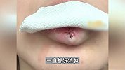 离谱！女子称嘴唇半年没消肿还有硬物感，去医院手术竟取出半颗牙