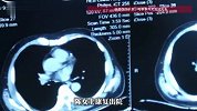31岁女子不抽烟，作息规律，陪母体检意外查出患肺癌，医生提醒