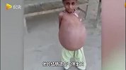 九岁就有啤酒肚！男孩身体骨瘦如柴却有巨大的肚子，走路活像孕妇！