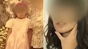 南京女子先天畸形 取大腿筋膜补脸