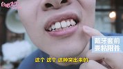 白眼初体验-隐形牙套正畸大揭秘