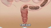 肠道里长息肉，上厕所会有四种提示，别等到中晚期了才知道