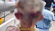 7岁女童被恶犬撕咬致毁容，父亲：近六小时手术，未脱离危险期