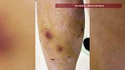女大学生校园内遭流浪狗围咬，持续半分钟咬伤20多处，越叫喊狗咬得越厉害