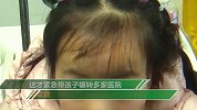 4岁女童从幼儿园回家后泪流不止 医生从眼内取出片状透明异物