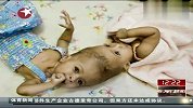 医学奇迹头部相连女婴成功分离