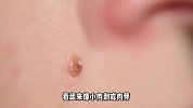 颈部和腋下长的“小肉疙瘩”是什么？能否随手掐掉？早知道早好