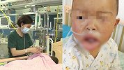 两岁男童误将消毒剂当饮品服下 嘴唇肿大如香肠急疯家长
