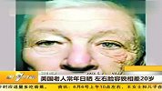 生活-美国老人常年日晒.左右脸容貌相差20岁
