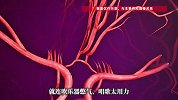 24岁小伙长期不明原因头痛确诊烟雾病，医生提醒