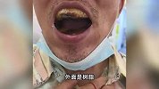 男子自行补牙致口腔糊满树脂，诊所、医院全不敢动：会致牙全脱落