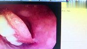 88岁老人吃香蕉误吞整排假牙 卡在食道30个小时