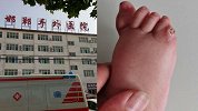 邯郸一幼儿小脚趾畸形 医生手术失误致截肢