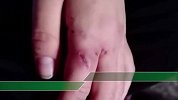 女孩惨遭继母家暴 妇联：继母曾不能生 生子后虐待她