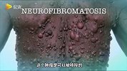 手术都无法根治！男子患神经肿瘤疾病脖子长满肿瘤，手术也具有风险！